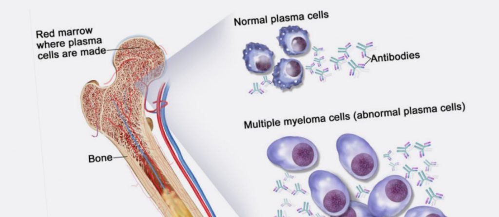 A New Hope for Myeloma